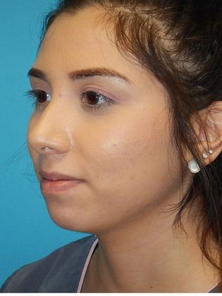 Before Image: Soft Tissue Fillers: Case 5 - left-front-oblique