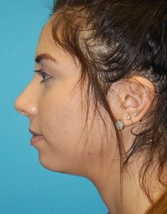 Before Image: Soft Tissue Fillers: Case 5 - left-side