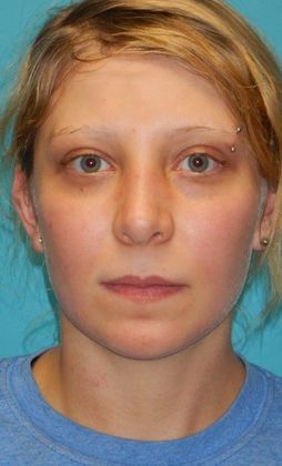 After Image: Rhinoplasty: Case 5 - front