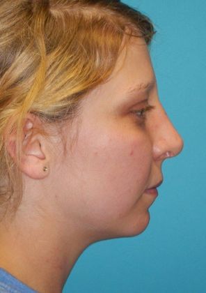 After Image: Rhinoplasty: Case 5 - right-side