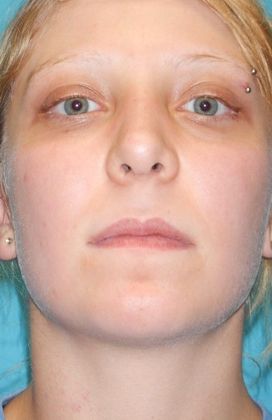 After Image: Rhinoplasty: Case 5 - front