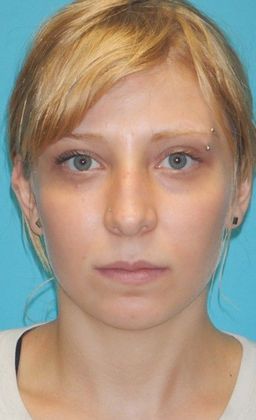 Before Image: Rhinoplasty: Case 5 - front