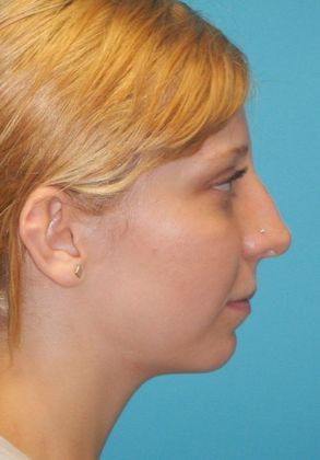 Before Image: Rhinoplasty: Case 5 - right-side