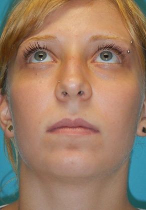 Before Image: Rhinoplasty: Case 5 - front