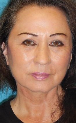 After Image: Fat Grafting Face: Case 5 - front