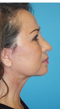 After Image: Fat Grafting Face: Case 5 - right-side
