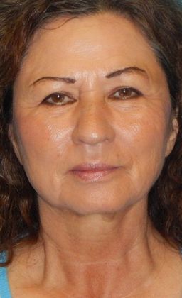 Before Image: Fat Grafting Face: Case 5 - front