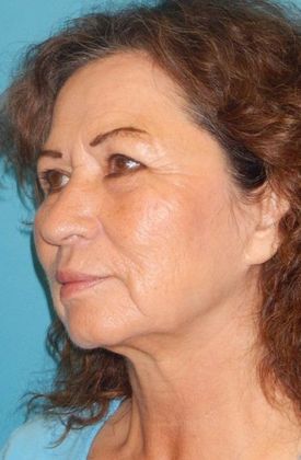 Before Image: Fat Grafting Face: Case 5 - left-front-oblique