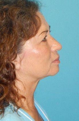 Before Image: Fat Grafting Face: Case 5 - right-side