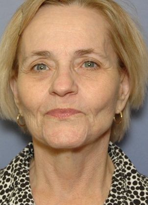 After Image: Neck Lift: Case 5 - front