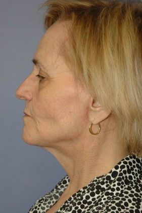 After Image: Neck Lift: Case 5 - left-side