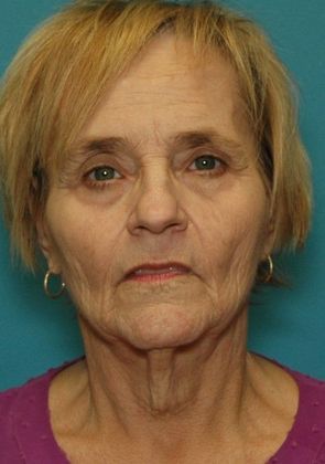Before Image: Neck Lift: Case 5 - front