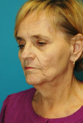 Before Image: Neck Lift: Case 5 - left-front-oblique