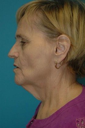Before Image: Neck Lift: Case 5 - left-side