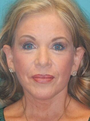 After Image: Face & Neck Lifts: Case 5