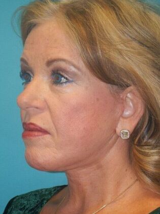 After Image: Face & Neck Lifts: Case 5 - left-side