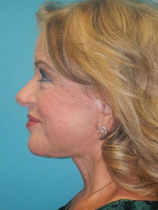 After Image: Face & Neck Lifts: Case 5 -