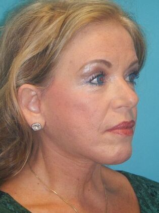 After Image: Face & Neck Lifts: Case 5 - right-front-oblique