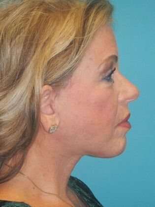 After Image: Face & Neck Lifts: Case 5 - right-side