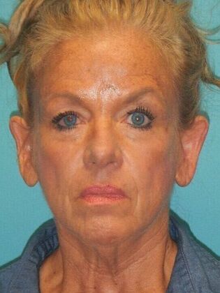 Before Image: Face & Neck Lifts: Case 5