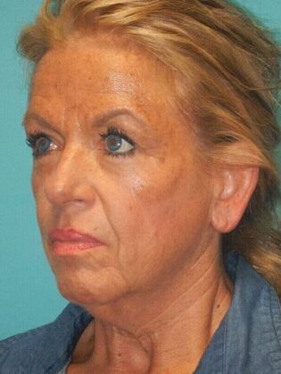 Before Image: Face & Neck Lifts: Case 5 - left-side