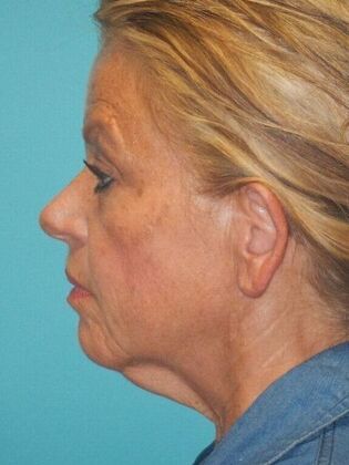 Before Image: Face & Neck Lifts: Case 5 -