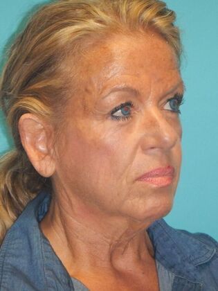Before Image: Face & Neck Lifts: Case 5 - right-front-oblique