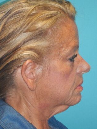 Before Image: Face & Neck Lifts: Case 5 - right-side
