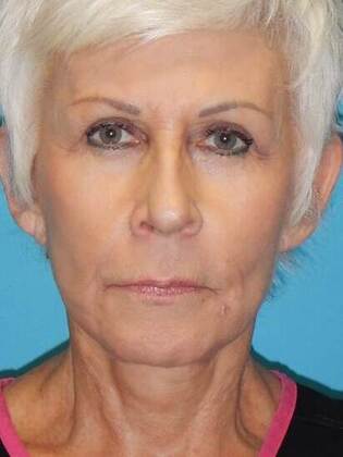 After Image: Face & Neck Lifts: Case 6 - front
