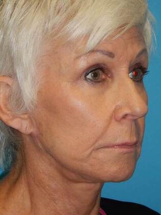 After Image: Face & Neck Lifts: Case 6 - right-front-oblique