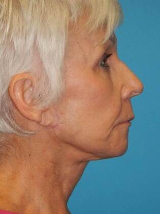 After Image: Face & Neck Lifts: Case 6 - right-side
