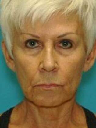 Before Image: Face & Neck Lifts: Case 6 - front