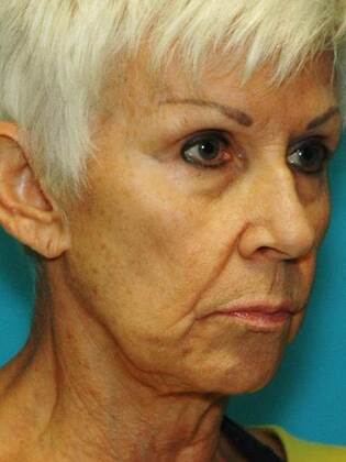 Before Image: Face & Neck Lifts: Case 6 - right-front-oblique