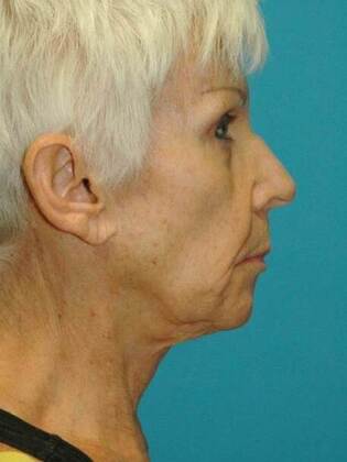 Before Image: Face & Neck Lifts: Case 6 - right-side