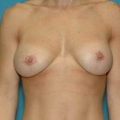 After Image: Breast Lift Augmentation: Case 6 - front