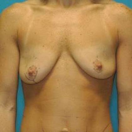 Before Image: Breast Lift Augmentation: Case 6 - front