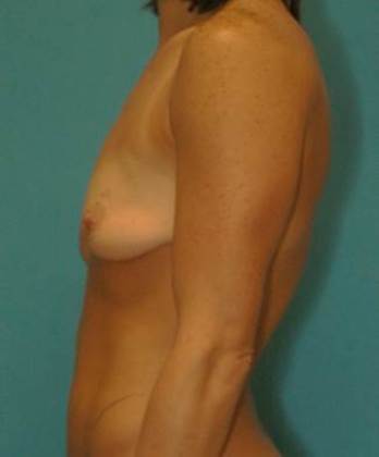 Before Image: Breast Lift Augmentation: Case 6 - left-side