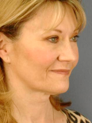 After Image: Mini Facelift: Case 6 - right-front-oblique