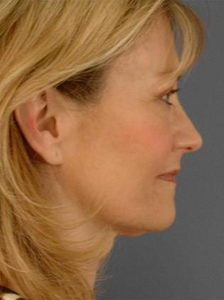 After Image: Mini Facelift: Case 6 - right-side