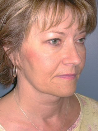 Before Image: Mini Facelift: Case 6 - right-front-oblique