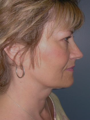 Before Image: Mini Facelift: Case 6 - right-side
