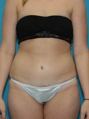 After Image: Abdominoplasty: Case 6 - front