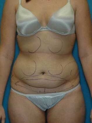 Before Image: Abdominoplasty: Case 6 - front