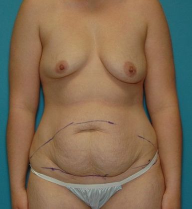 Before Image: Mommy Makeover: Case 6 - front