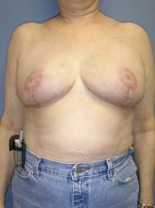 After Image: Breast Reduction: Case 6 - front