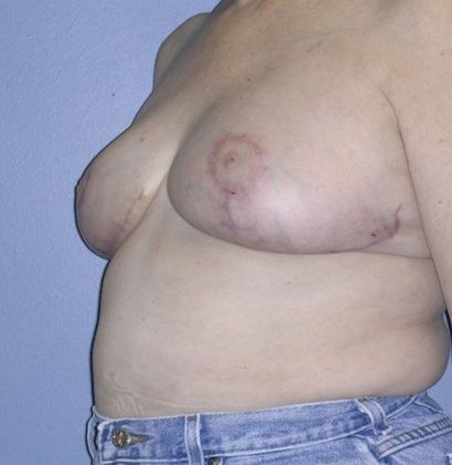 After Image: Breast Reduction: Case 6 - left-front-oblique