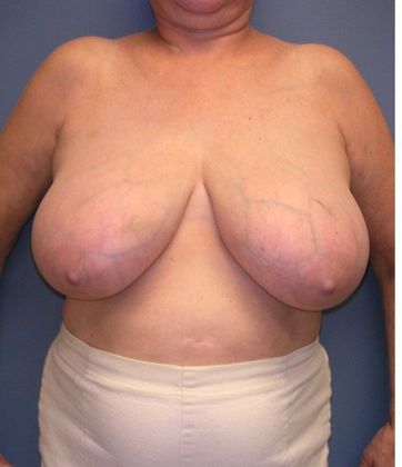Before Image: Breast Reduction: Case 6 - front