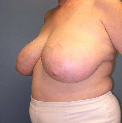 Before Image: Breast Reduction: Case 6 - left-front-oblique