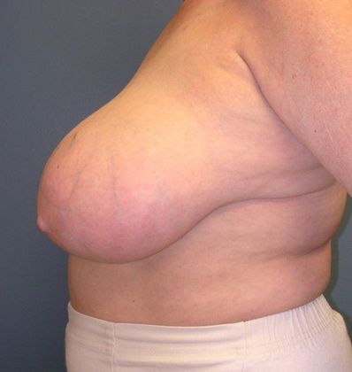 Before Image: Breast Reduction: Case 6 - left-side