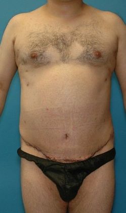 After Image: Liposuction: Case 6 - front